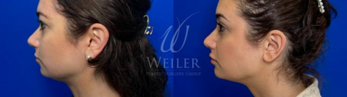 Before & After Chin Augmentation Case 1262 Front View in Baton Rouge, New Orleans, & Lafayette, Louisiana