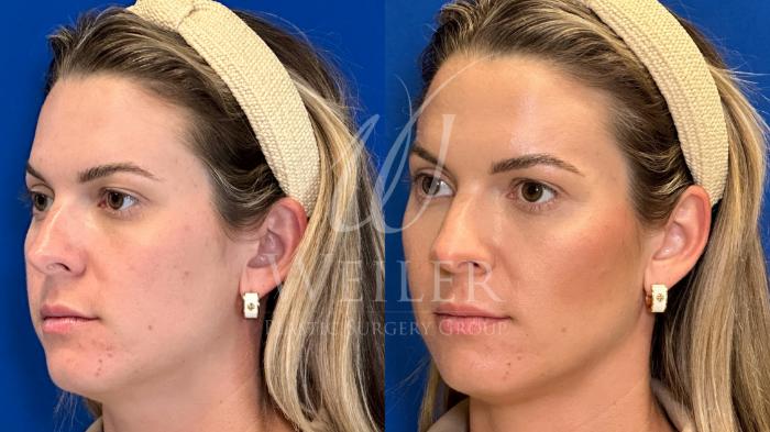 Before & After Chin Augmentation Case 1345 Left Side View in Baton Rouge, New Orleans, & Lafayette, Louisiana