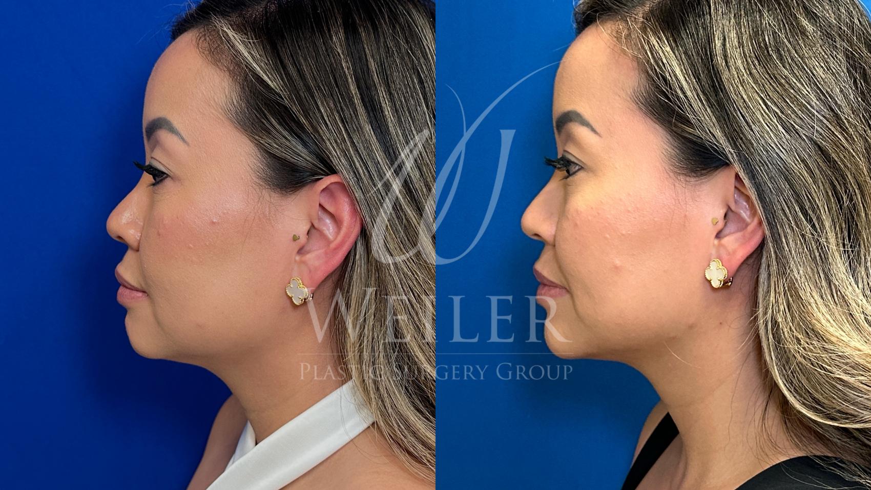 Chin Augmentation Before and After Pictures Case 1351 | Baton Rouge ...