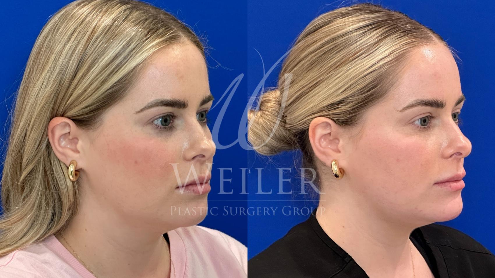 Before & After Chin Augmentation Case 1372 Left Side View in Baton Rouge, New Orleans, & Lafayette, Louisiana