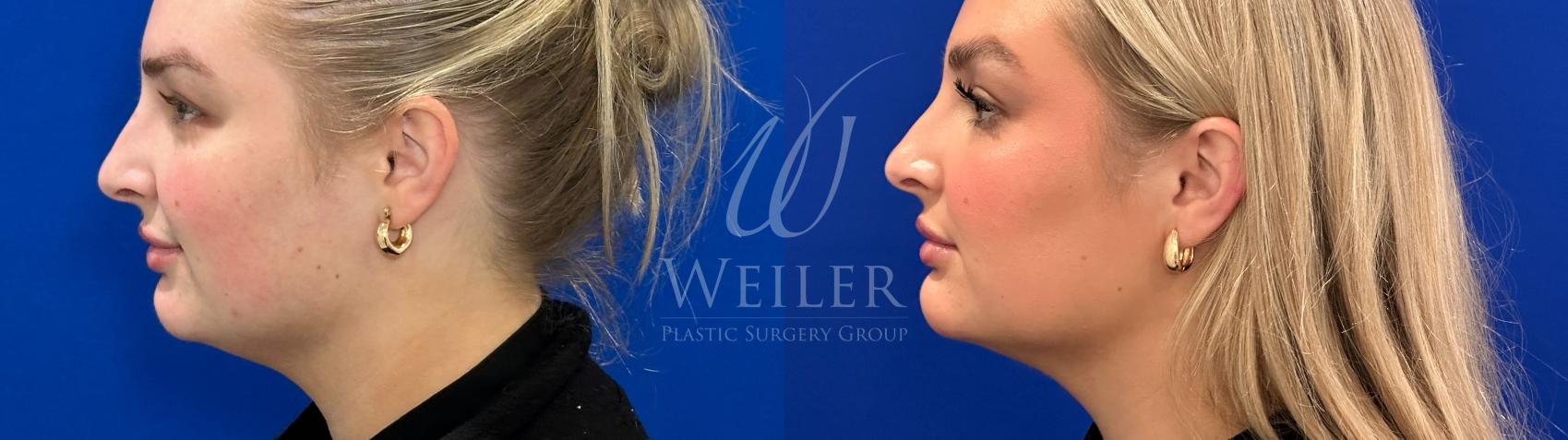 Before & After Chin Augmentation Case 1384 Left Side View in Baton Rouge, New Orleans, & Lafayette, Louisiana