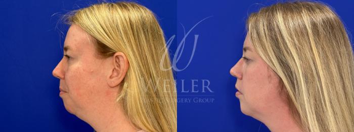 Before & After Chin Augmentation Case 1583 Left Side View in Baton Rouge, New Orleans, & Lafayette, Louisiana