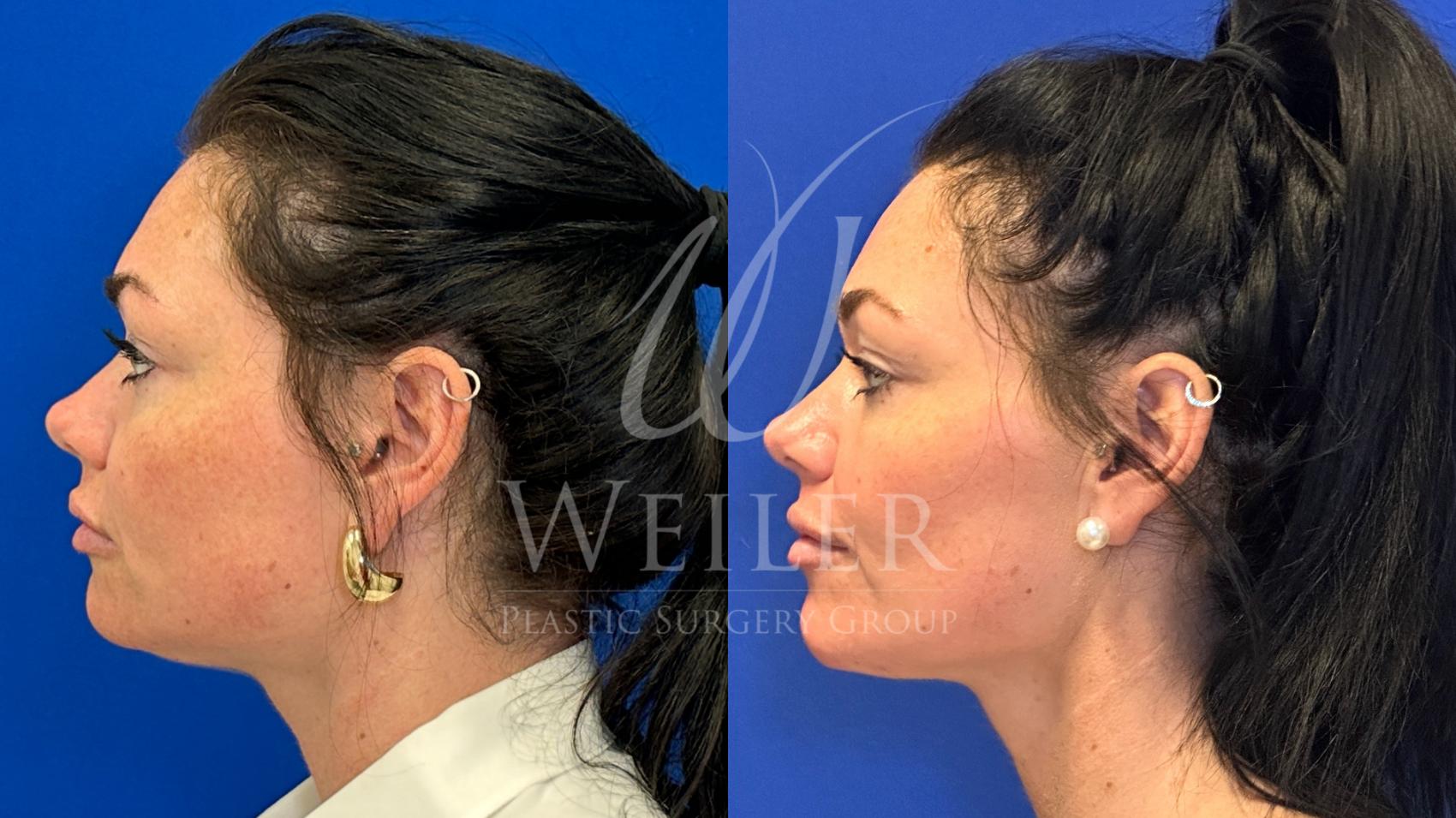 Before & After Chin Augmentation Case 1584 Left Side View in Baton Rouge, New Orleans, & Lafayette, Louisiana