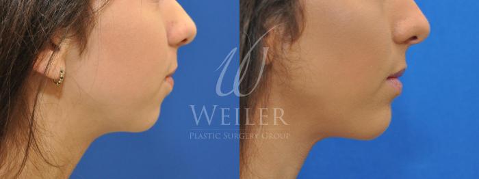 Before & After JUVÉDERM® Case 523 Right Side View in Baton Rouge, Louisiana