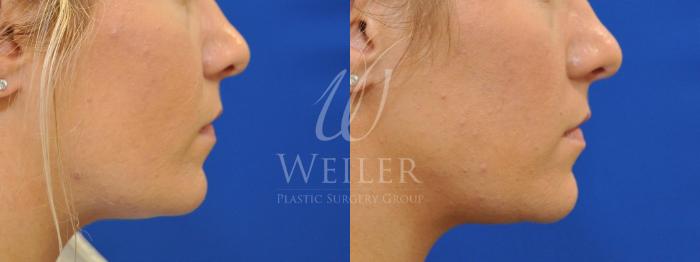 Before & After Chin Augmentation Case 524 Right Side View in Baton Rouge, New Orleans, & Lafayette, Louisiana