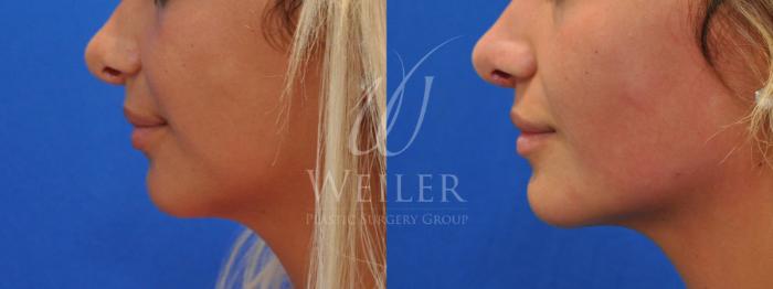 Before & After Chin Augmentation Case 525 Left Side View in Baton Rouge, Louisiana