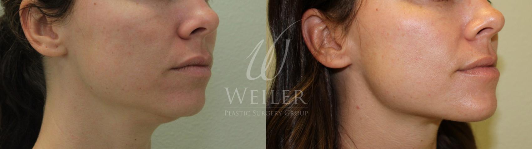 Before & After Chin Augmentation Case 600 Right Oblique View in Baton Rouge, New Orleans, & Lafayette, Louisiana