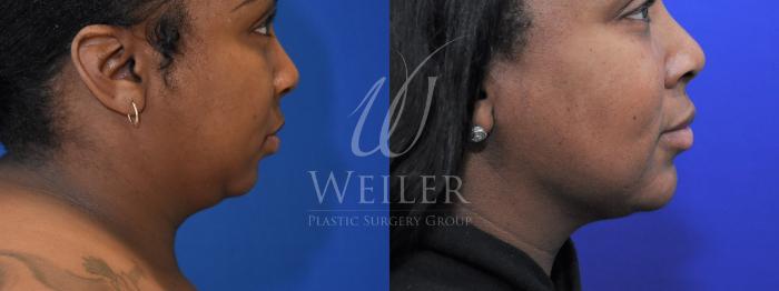 Before & After Chin Augmentation Case 927 Right Side View in Baton Rouge, New Orleans, & Lafayette, Louisiana