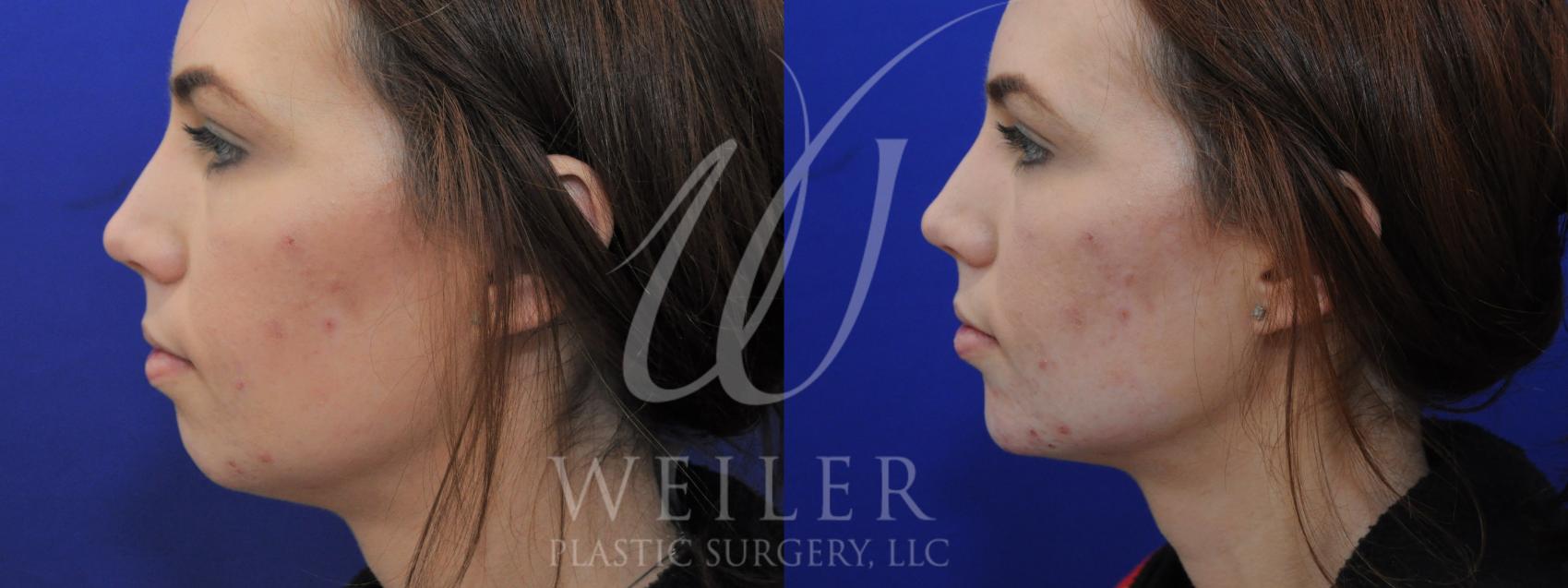 Before & After Chin Augmentation Case 935 Left Side View in Baton Rouge, New Orleans, & Lafayette, Louisiana