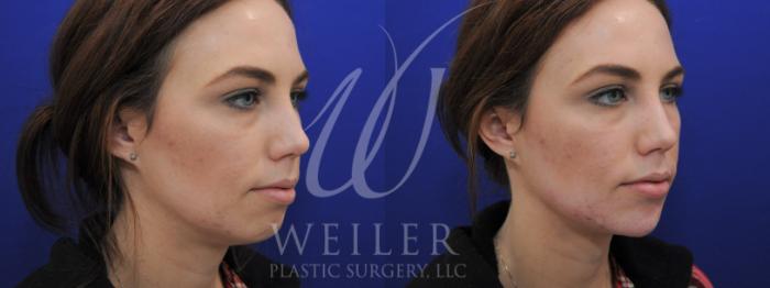 Before & After Chin Augmentation Case 935 Right Side View in Baton Rouge, New Orleans, & Lafayette, Louisiana