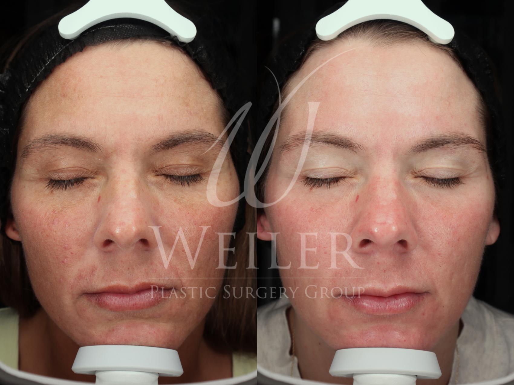 Before & After Cool Peel Laser Case 1755 Front View in Baton Rouge, New Orleans, & Lafayette, Louisiana
