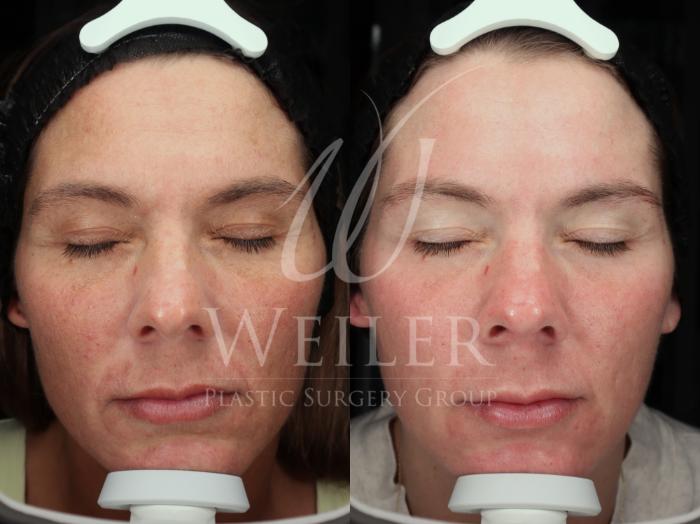 Before & After Cool Peel Laser Case 1755 Front View in Baton Rouge, New Orleans, & Lafayette, Louisiana
