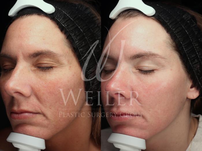 Before & After Cool Peel Laser Case 1755 Left Oblique View in Baton Rouge, New Orleans, & Lafayette, Louisiana