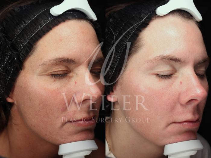 Before & After Cool Peel Laser Case 1755 Right Oblique View in Baton Rouge, New Orleans, & Lafayette, Louisiana