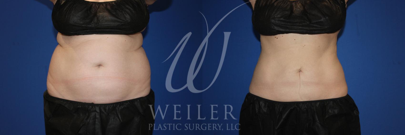 Before & After CoolSculpting Case 1007 Front View in Baton Rouge, Louisiana