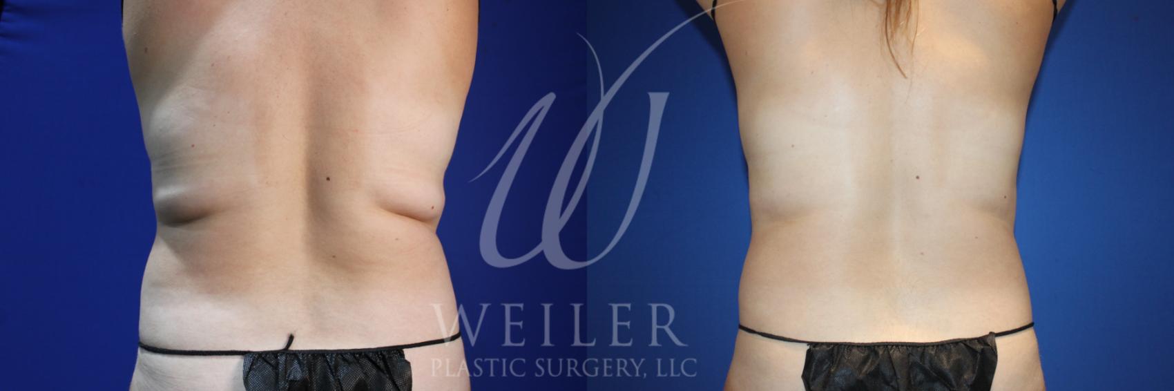 Before & After CoolSculpting Case 1008 Back View in Baton Rouge, Louisiana