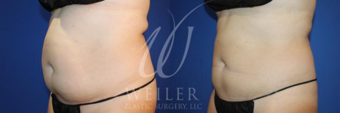 Tummy Tuck Before and After Photo Gallery, Baton Rouge, Louisiana