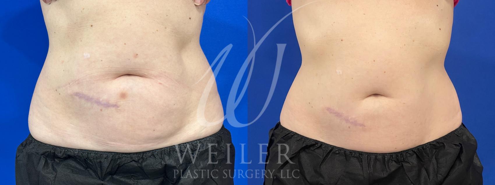 Before & After CoolSculpting Case 1040 Front View in Baton Rouge, New Orleans, & Lafayette, Louisiana