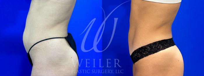 Before & After CoolSculpting Case 1068 Left Side View in Baton Rouge, New Orleans, & Lafayette, Louisiana