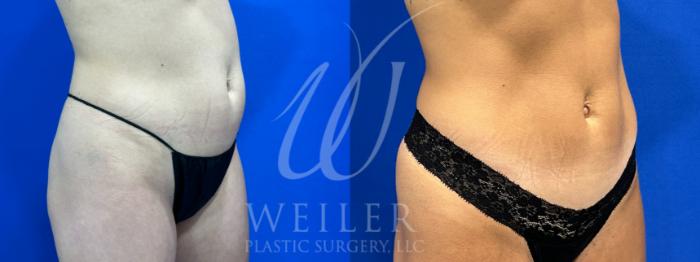 Before & After CoolSculpting Case 1068 Right Oblique View in Baton Rouge, New Orleans, & Lafayette, Louisiana