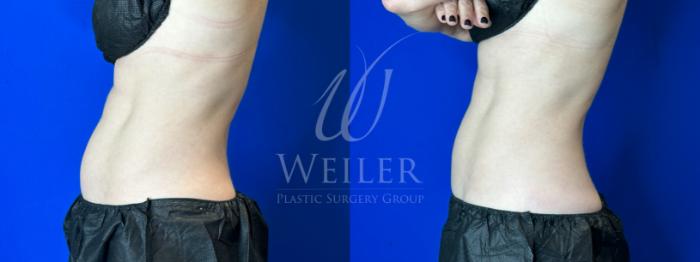 Before & After CoolSculpting Case 1138 Left Side View in Baton Rouge, New Orleans, & Lafayette, Louisiana