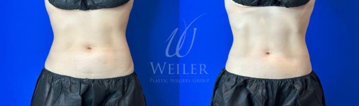 Before & After CoolSculpting Case 1194 Front View in Baton Rouge, New Orleans, & Lafayette, Louisiana