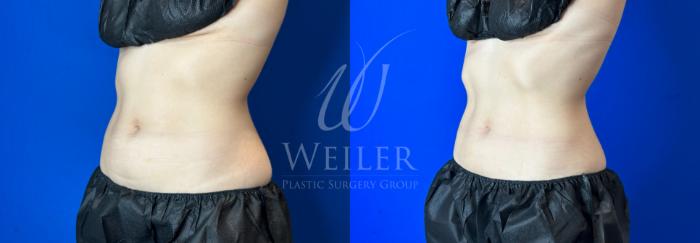 Before & After CoolSculpting Case 1194 Left Oblique View in Baton Rouge, New Orleans, & Lafayette, Louisiana