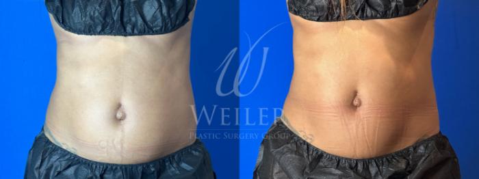Before & After CoolSculpting Case 1195 Front View in Baton Rouge, New Orleans, & Lafayette, Louisiana