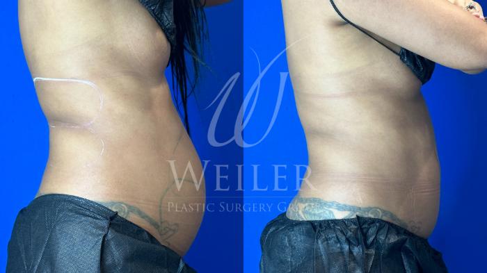 Before & After CoolSculpting Case 1195 Left Side View in Baton Rouge, New Orleans, & Lafayette, Louisiana