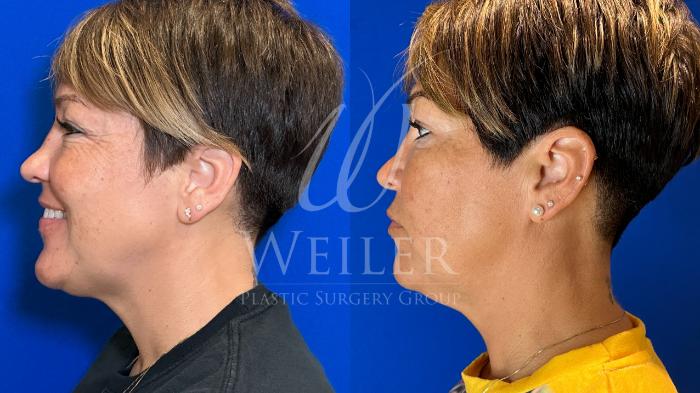Before & After CoolSculpting Case 1268 Right Side View in Baton Rouge, New Orleans, & Lafayette, Louisiana