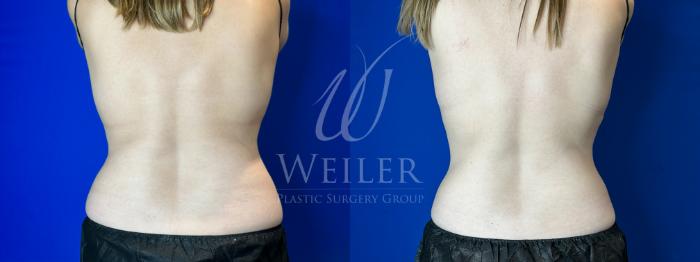 Before & After CoolSculpting Case 1306 Back View in Baton Rouge, New Orleans, & Lafayette, Louisiana