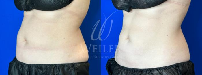Before & After CoolSculpting Case 1306 Right Oblique View in Baton Rouge, New Orleans, & Lafayette, Louisiana