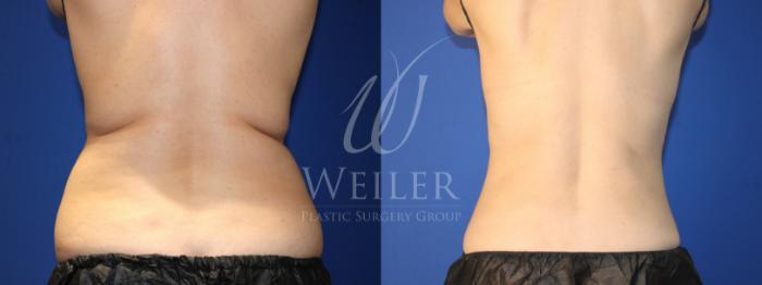 Before & After CoolSculpting Case 1369 Back View in Baton Rouge, New Orleans, & Lafayette, Louisiana