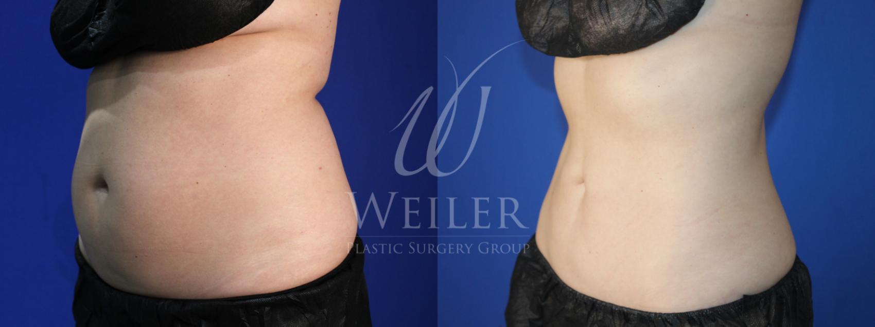 Before & After CoolSculpting Case 1369 Left Oblique View in Baton Rouge, New Orleans, & Lafayette, Louisiana