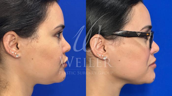 Before & After CoolSculpting Case 1433 Right Side View in Baton Rouge, New Orleans, & Lafayette, Louisiana