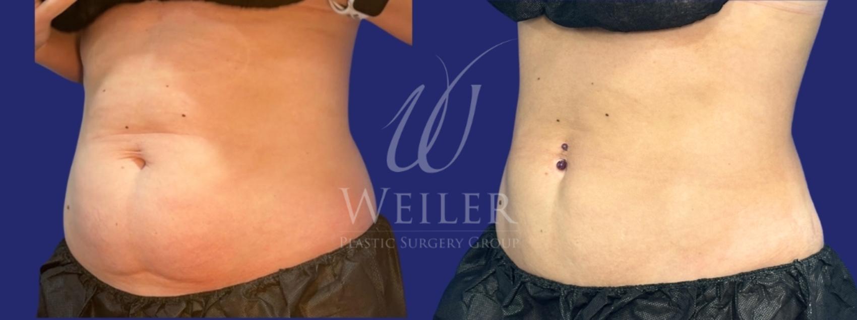 Before & After CoolSculpting Case 1547 Left Oblique View in Baton Rouge, New Orleans, & Lafayette, Louisiana