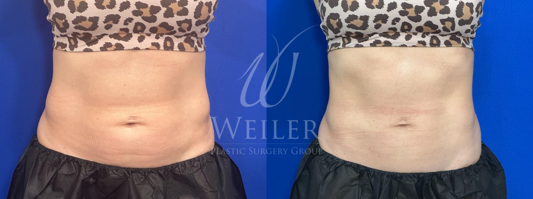 Before & After CoolSculpting Case 1575 Front View in Baton Rouge, New Orleans, & Lafayette, Louisiana