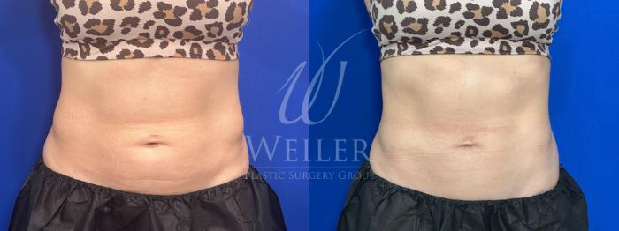 Before & After CoolSculpting Case 1575 Front View in Baton Rouge, New Orleans, & Lafayette, Louisiana