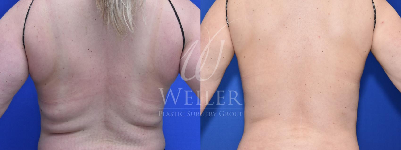 Before & After CoolSculpting Case 716 Back View in Baton Rouge, Louisiana