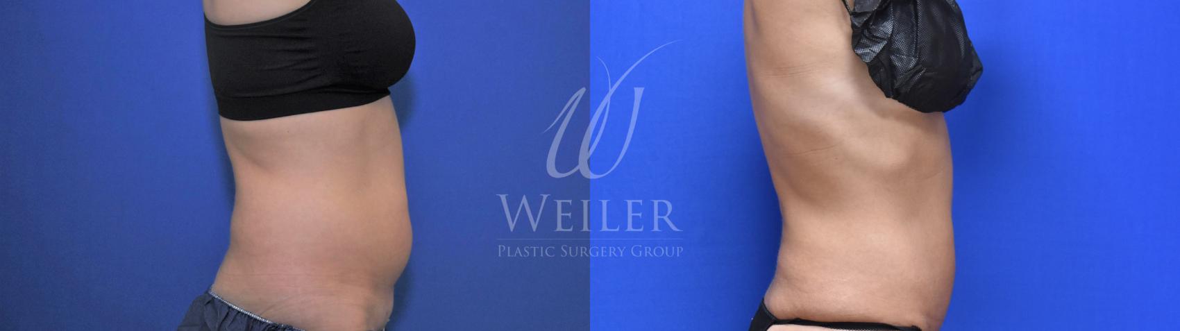 Before & After CoolSculpting Case 717 Right Side View in Baton Rouge, Louisiana
