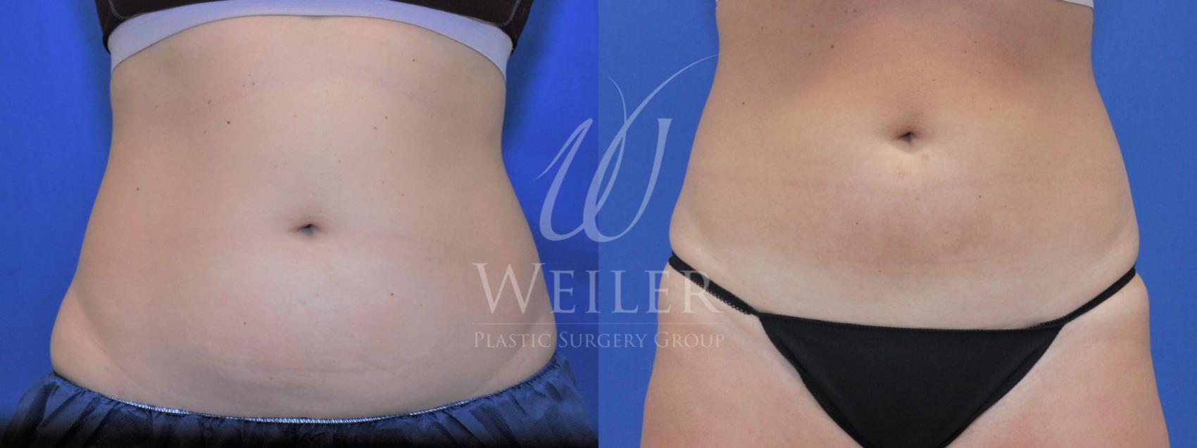 Before & After CoolSculpting Case 720 Front View in Baton Rouge, Louisiana