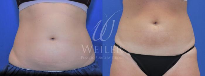 Before & After CoolSculpting Case 720 Front View in Baton Rouge, New Orleans, & Lafayette, Louisiana