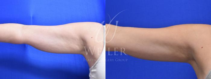 Before & After CoolSculpting Case 721 Front View in Baton Rouge, New Orleans, & Lafayette, Louisiana
