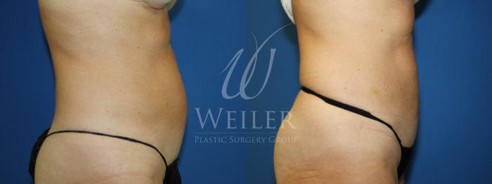 Before & After CoolSculpting Case 722 Right Side View in Baton Rouge, New Orleans, & Lafayette, Louisiana