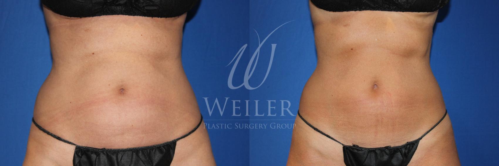Before & After CoolSculpting Case 801 Front View in Baton Rouge, Louisiana