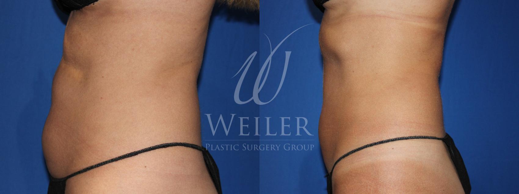 Before & After CoolSculpting Case 801 Left Side View in Baton Rouge, Louisiana