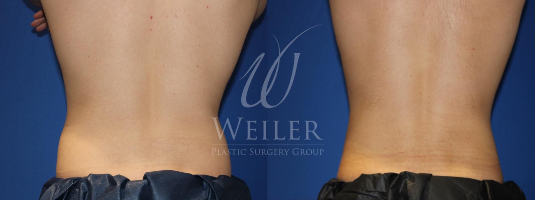 CoolSculpting Flanks (Love Handles) Before & After Photos - Cosmetic -  Ark-La-Tex Dermatology & Medical Spa - Louisiana - A Part of the  Willis-Knighton Physician Network