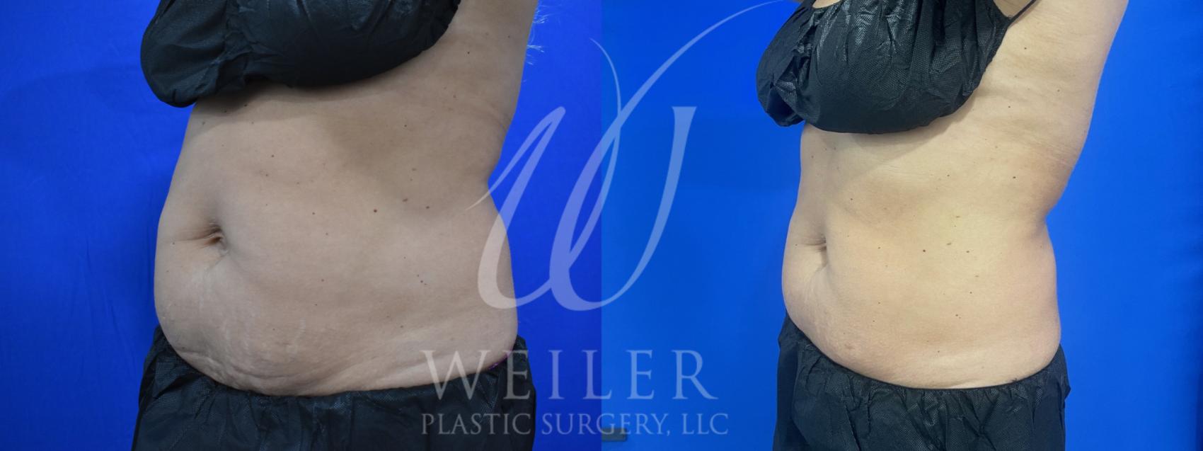 Before & After CoolSculpting Case 925 Left Oblique View in Baton Rouge, Louisiana