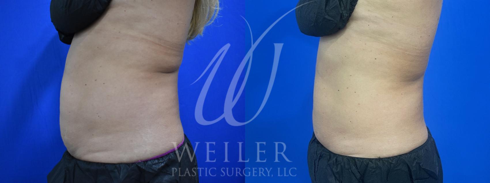 Before & After CoolSculpting Case 925 Left Side View in Baton Rouge, Louisiana
