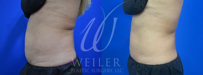 Before & After CoolSculpting Case 925 Left Side View in Baton Rouge, New Orleans, & Lafayette, Louisiana
